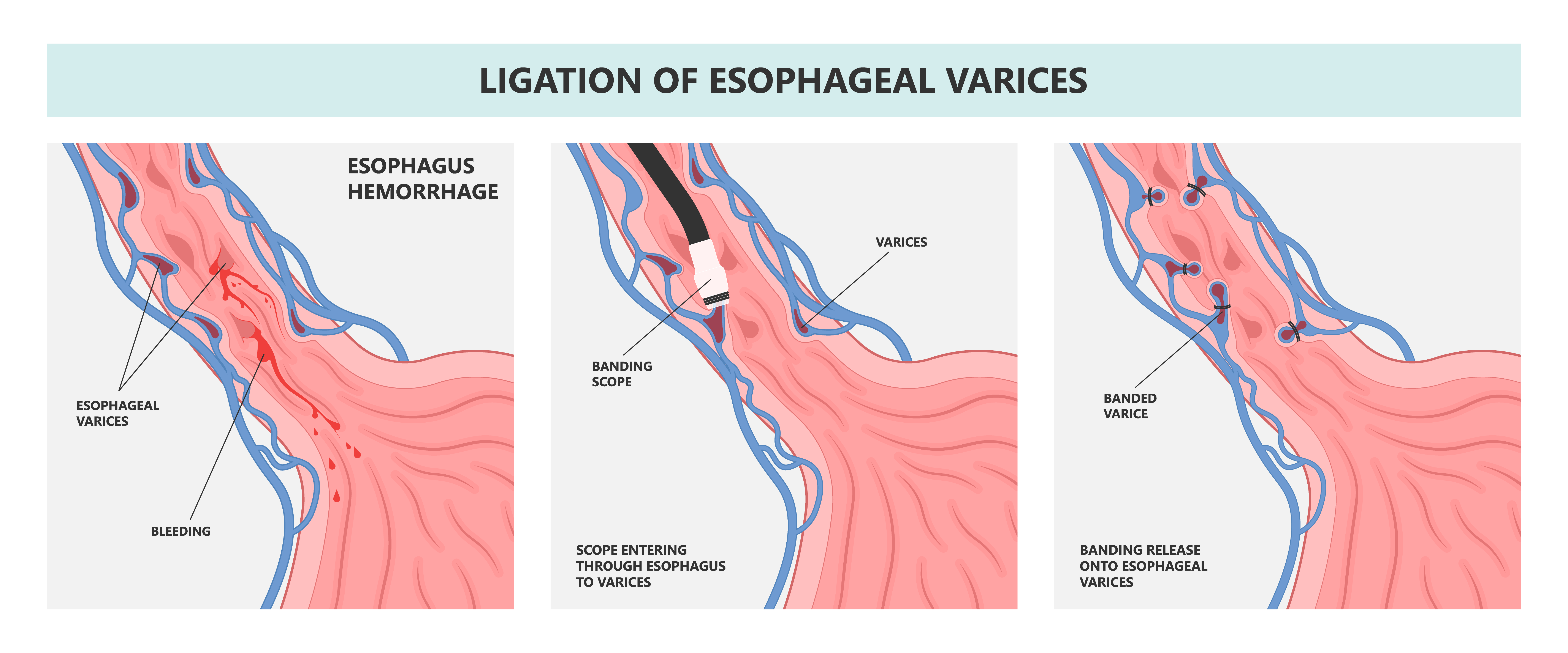 Esophageal Varices Banding Esophageal Varices Banding